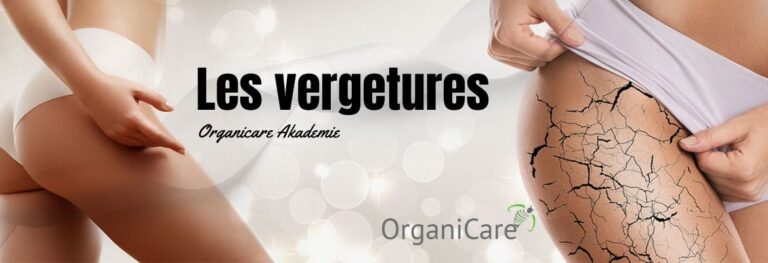 Les vergetures, connaissance et traitement