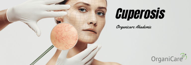 Cuperosis Clinic and treatment