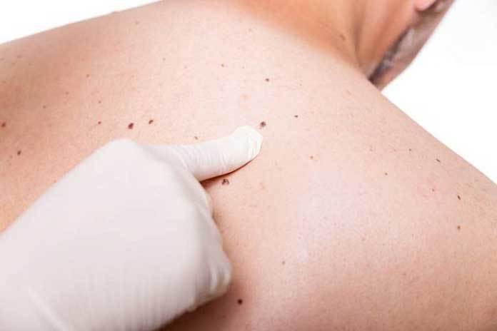 Taches de peau (sénile) : Tout Savoir
